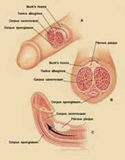 Induratio penis plastica - (IPP) Induratio penis plastica - (IPP)